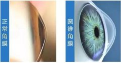 成都爱尔眼科圆锥角膜科普:配了眼镜