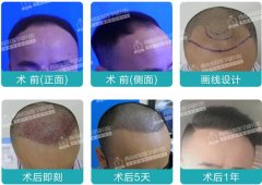 植发医生赵阳:植发,为什么能解决脱