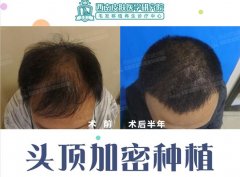 植发医生赵阳院长:怎样选择植发医院