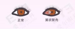 成都爱尔眼科:翼状胬肉是种什么病,
