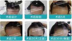 医生赵阳植发怎么样?植发时可听歌看