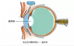 治疗白内障的有效方法是什么?成都爱