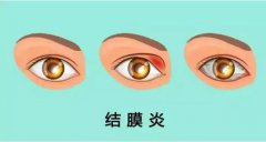 成都爱尔眼科科普:眼睛发红,你可能